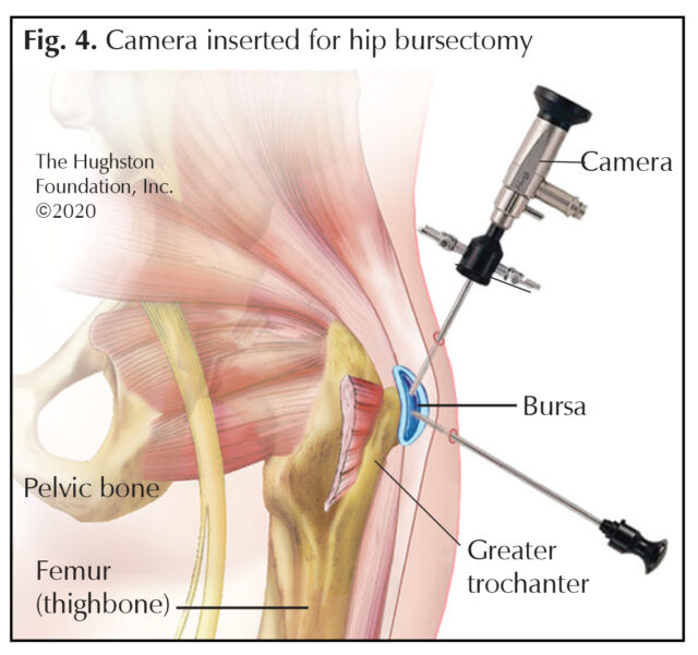 Greater Trochanteric Bursitis A Common Cause Of Hip Pain Hughston