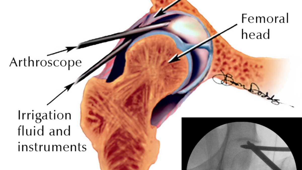 Rehabilitation After Arthroscopic Surgery Hughston Clinic