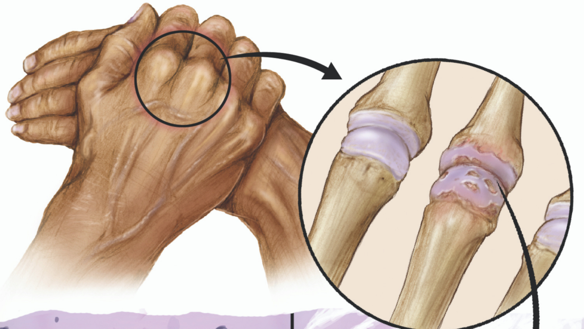 Arthritis Figure