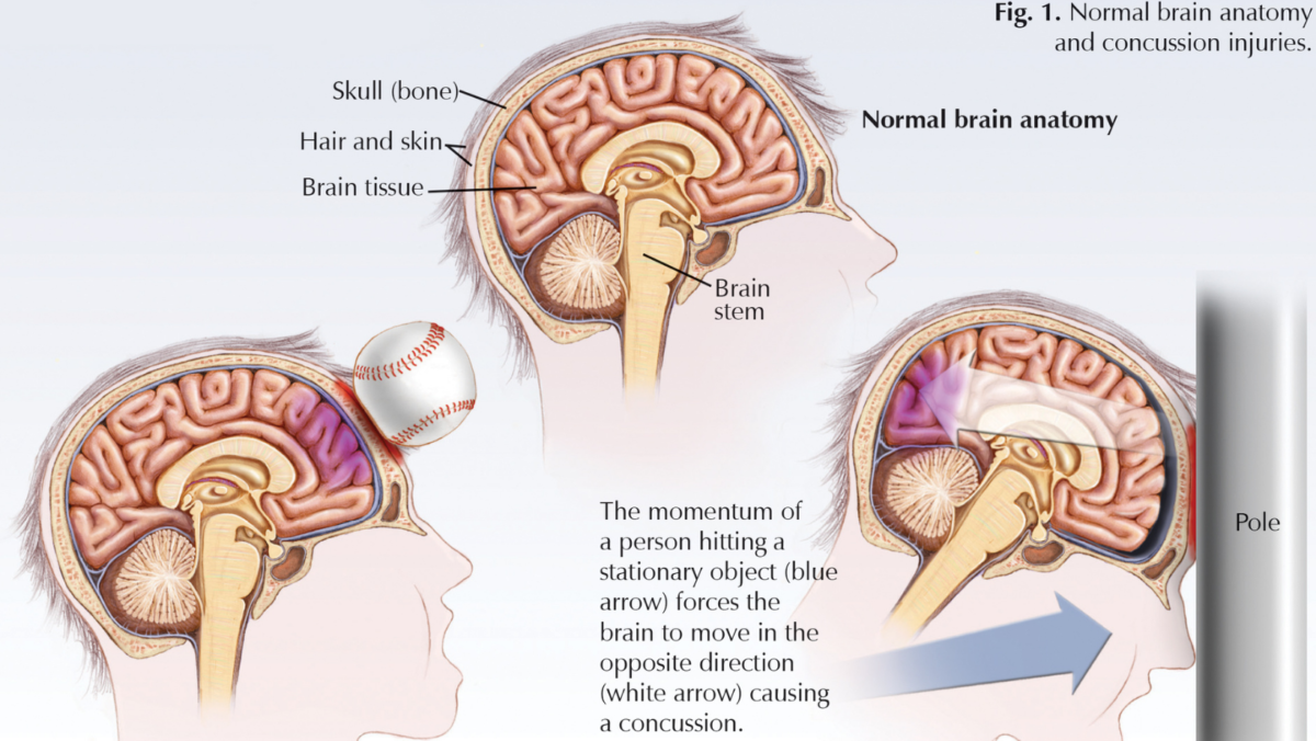 Normal brain anatomy and concussion injuries