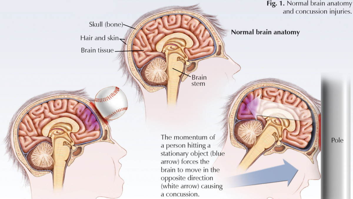 after effects of concussion