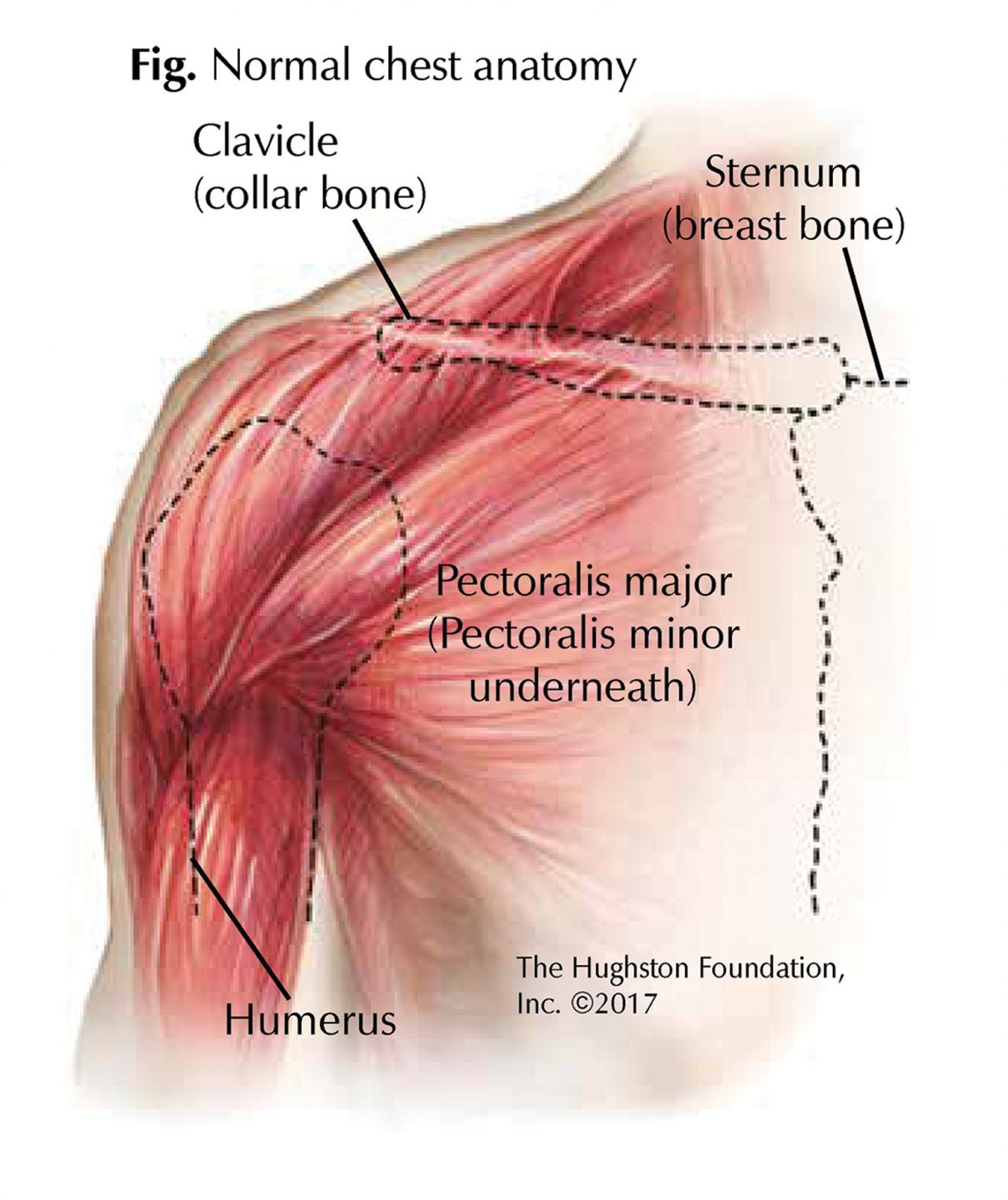 Different Types Of Chest Muscle Injuries