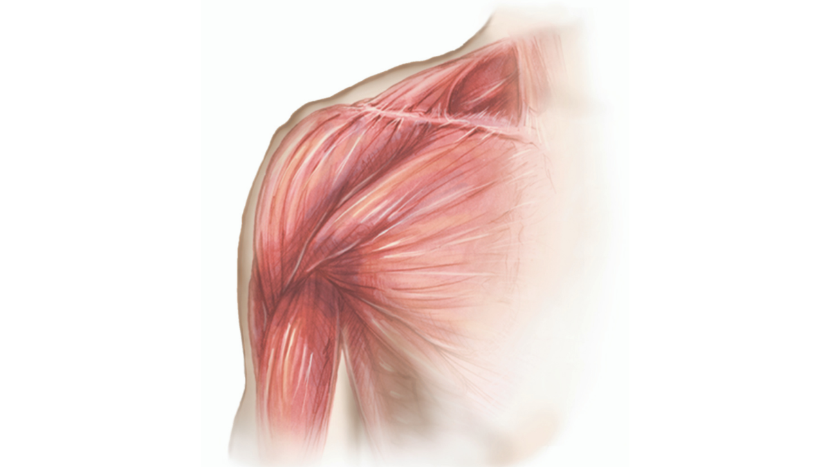 Examples of pectoralis major (PM) muscle trauma associated with breast