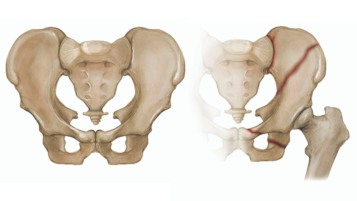 Recovery exercises for pelvic injury - After Trauma