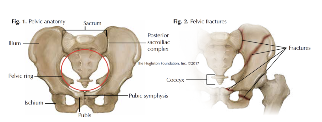 Types of Pelvis Fractures