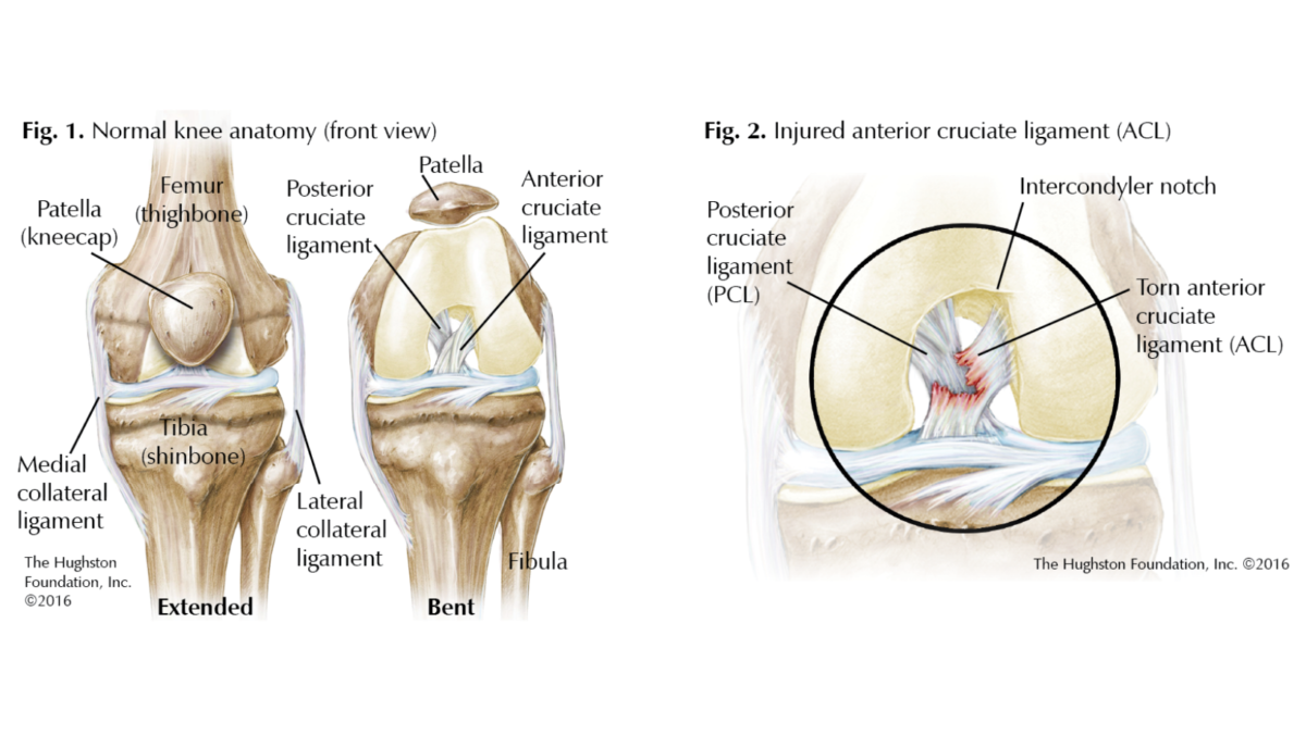 Anterior Cruciate Ligament (ACL) & Medial Collateral Knee Ligament