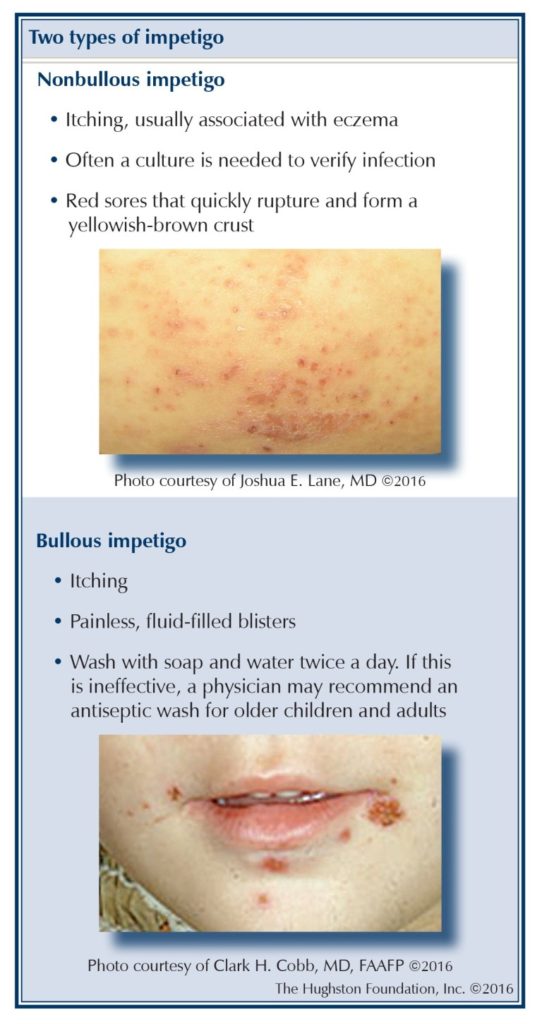 impetigo-a-concern-for-athletes-hughston-clinic