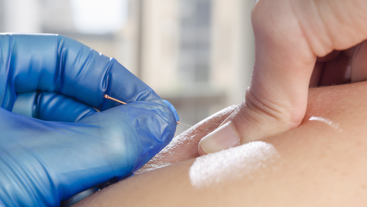 Dry Needling: What You Should Know - Hughston Clinic