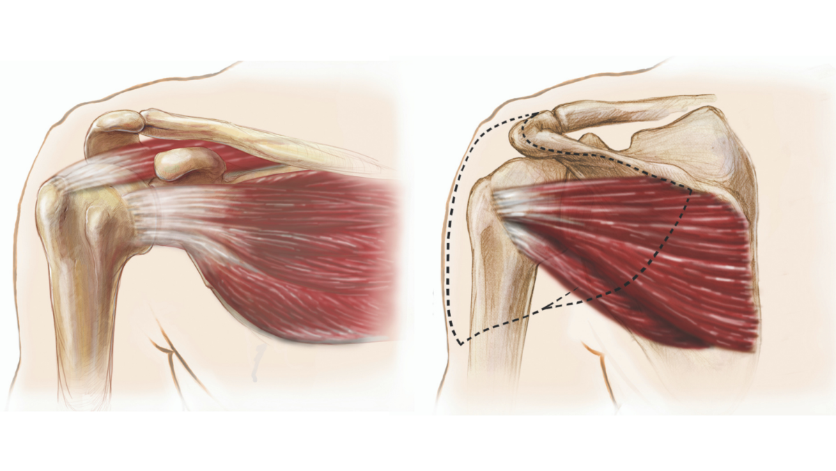 Shoulder deals muscle tear