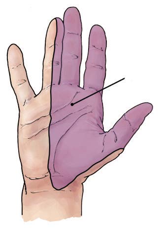 Illustration of hand with median nerve supply area highlighted.
