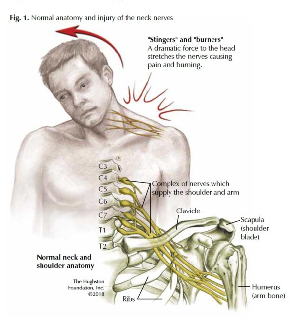 brachial plexus lesions