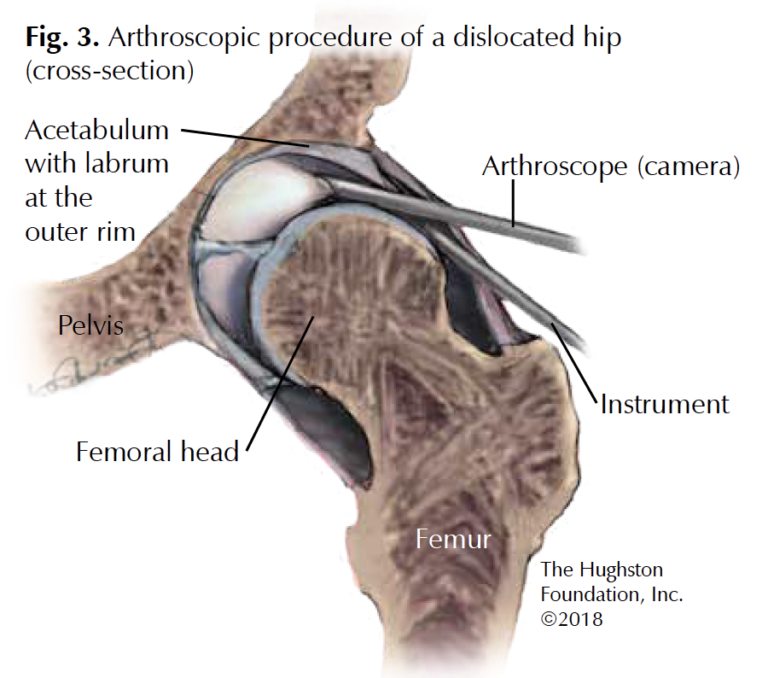 hip-arthroscopy-hughston-clinic