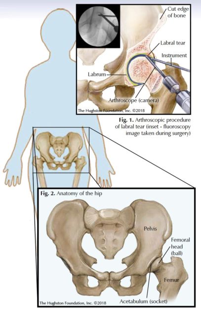 Hip Arthroscopy - Hughston Clinic