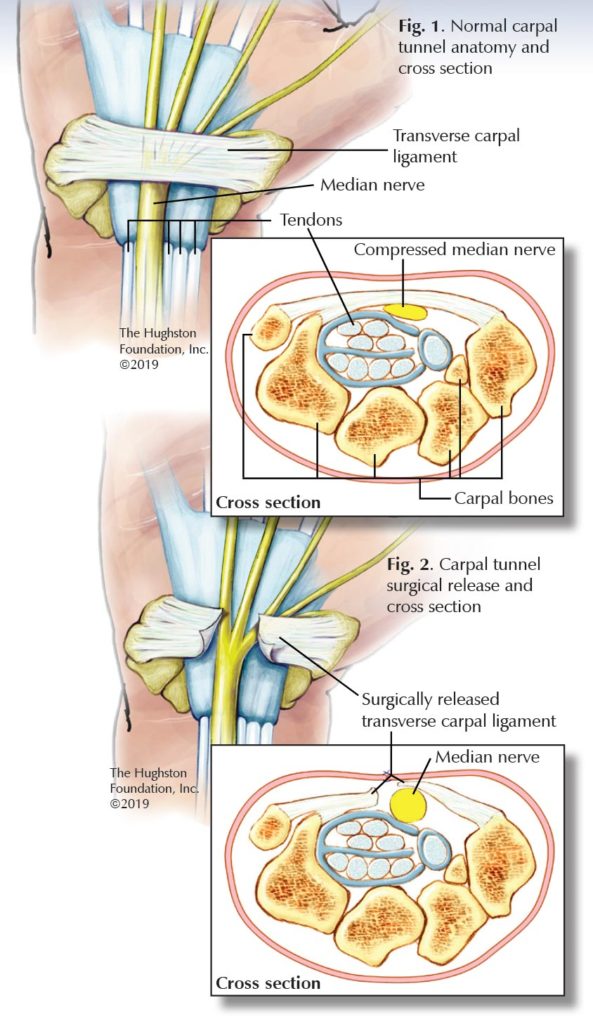 Carpal tunnel