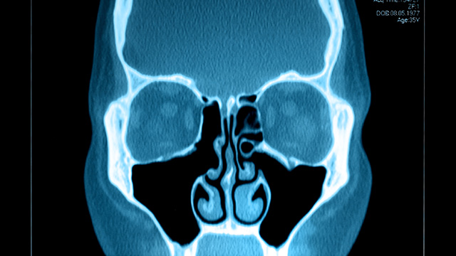 X-Ray of Sinus Cavity