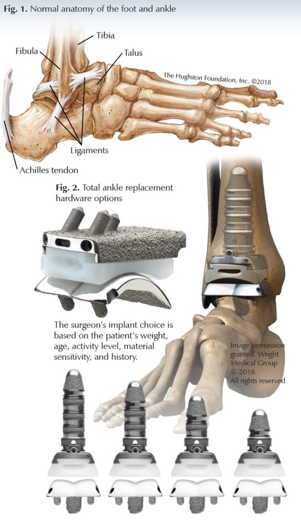 Total Ankle Arthroplasty Questions For A Specialist Hughston Clinic