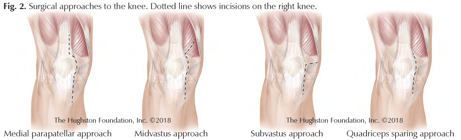 Surgical Approaches to Knee and Hip Replacement - Hughston Clinic