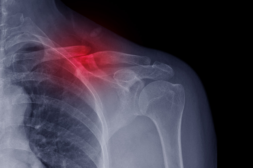 X-Ray of broken collar bone