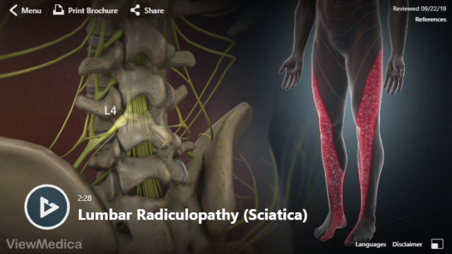 Video Lumbar Radiculopathy Sciatica Hughston Clinic