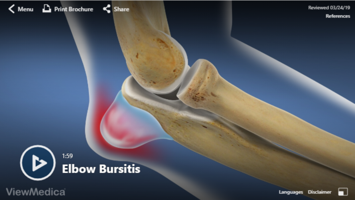 Video: Elbow Bursitis