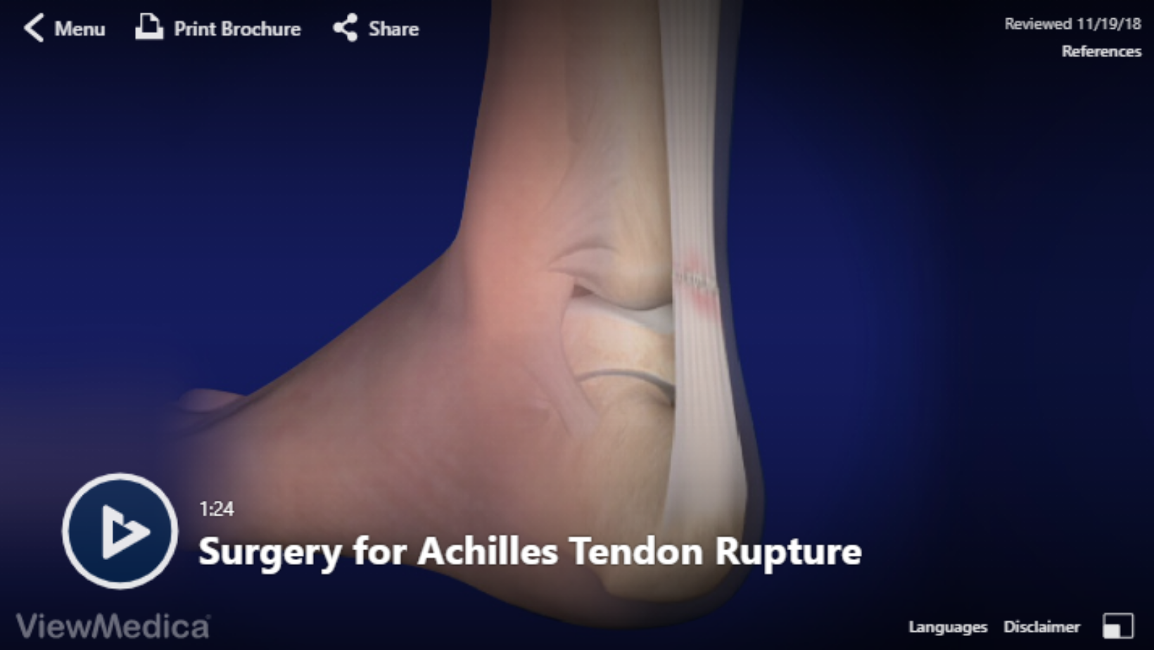 Surgery for Achilles Tendon Rupture Video