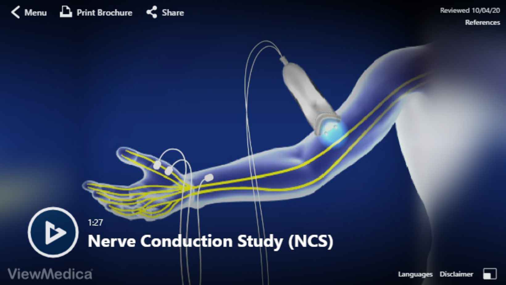 Nerve Conduction Study Video
