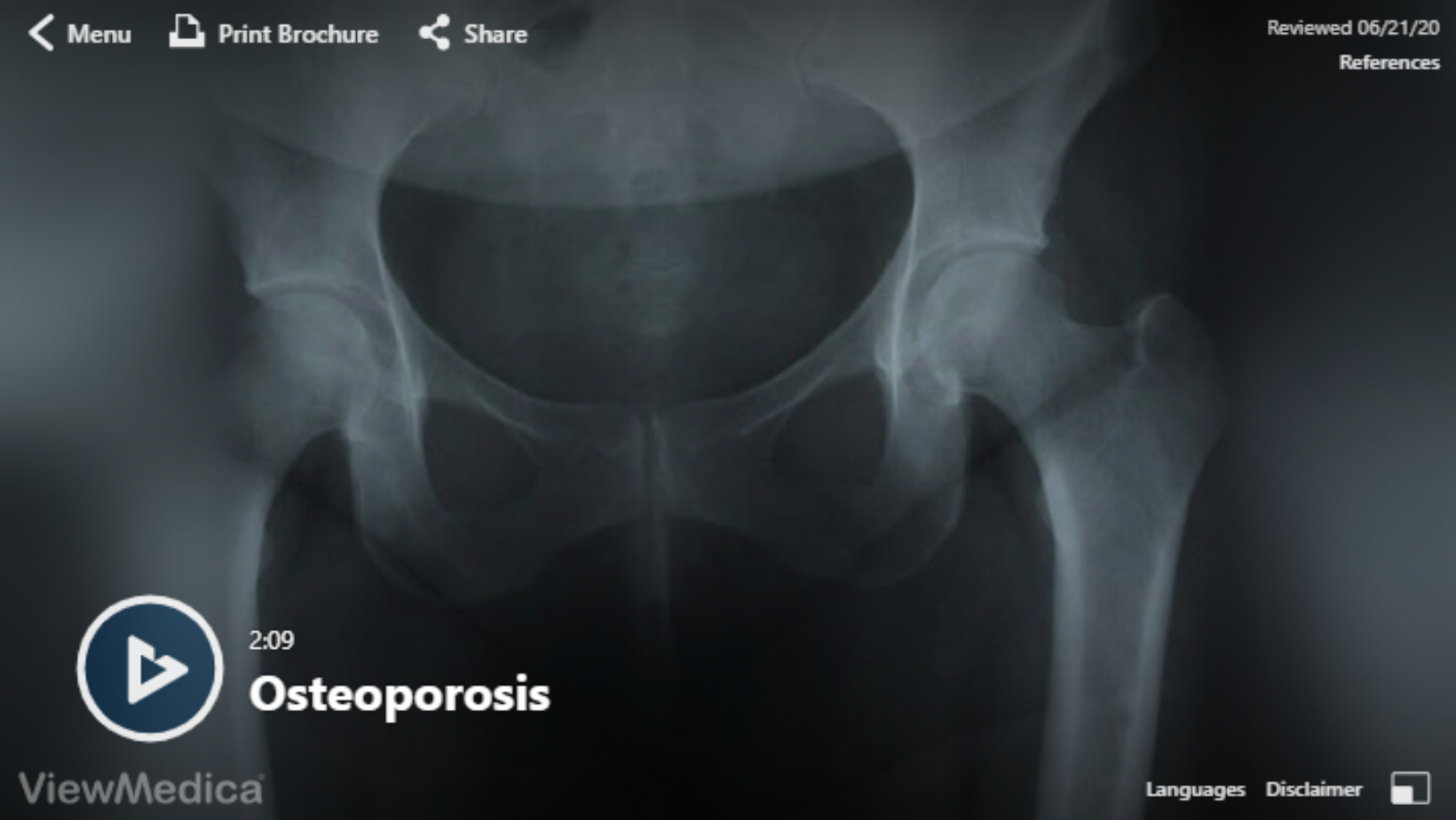 Osteoporosis Video