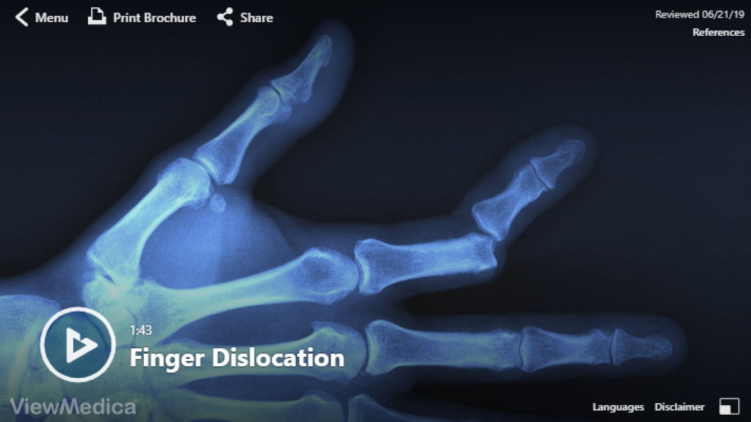 video-finger-dislocation-hughston-clinic