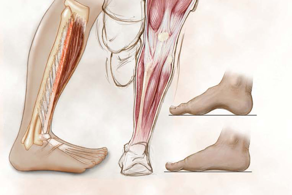 muscles medial tibial stress syndrome