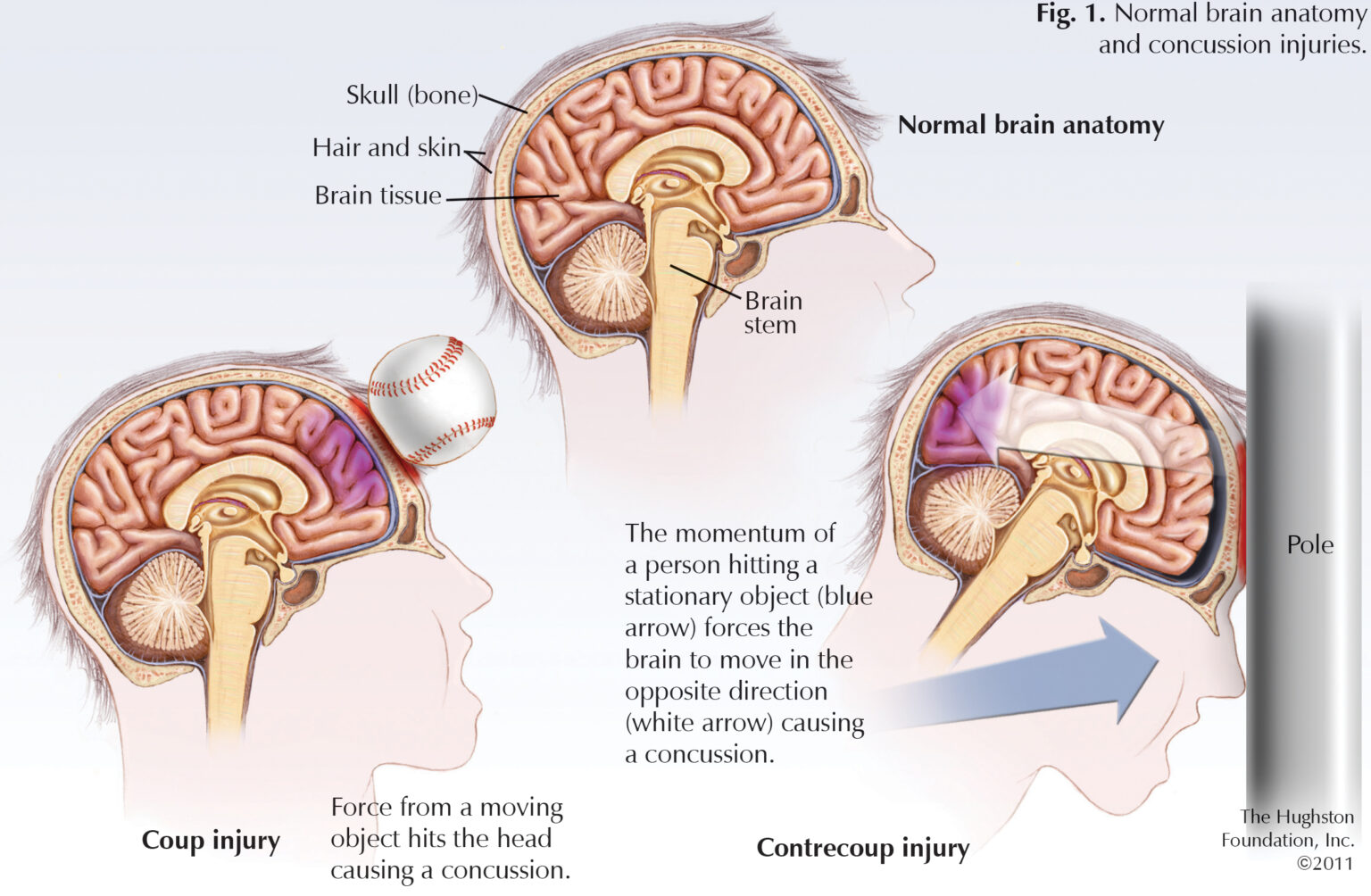 Are Concussions Serious In Toddlers