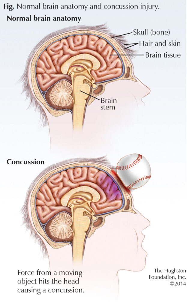 Concussions & ImPACT Testing Guidelines for Athletes - Hughston Clinic