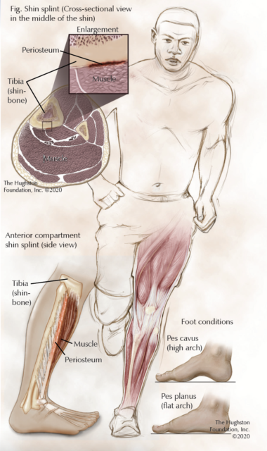 Shin Splints, Shin Pain & and its Symptoms