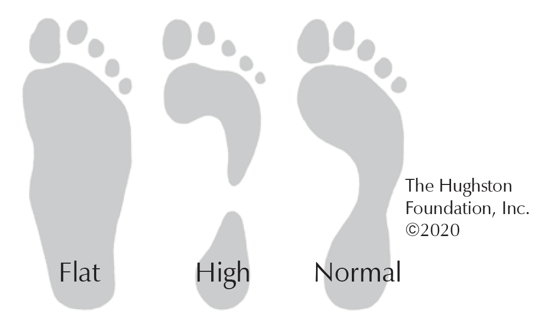 Fallen Arches Hughston Clinic