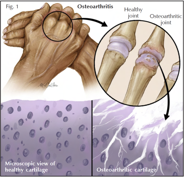 3 Common Myths About Wearing A Brace - OMA - Oh My Arthritis