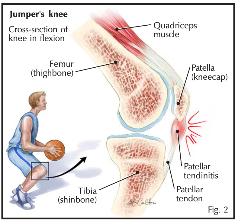 Колено прыгуна тендинит надколенника. Тендинит сухожилия надколенника. Колено прыгуна Собственная связка надколенника.