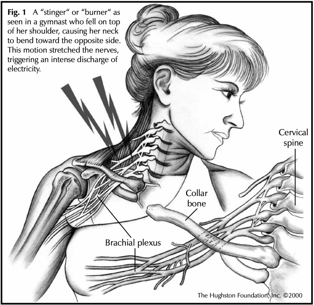 Chest Muscle Injuries: Strains and Tears of the Pectoralis Major - Hughston  Clinic