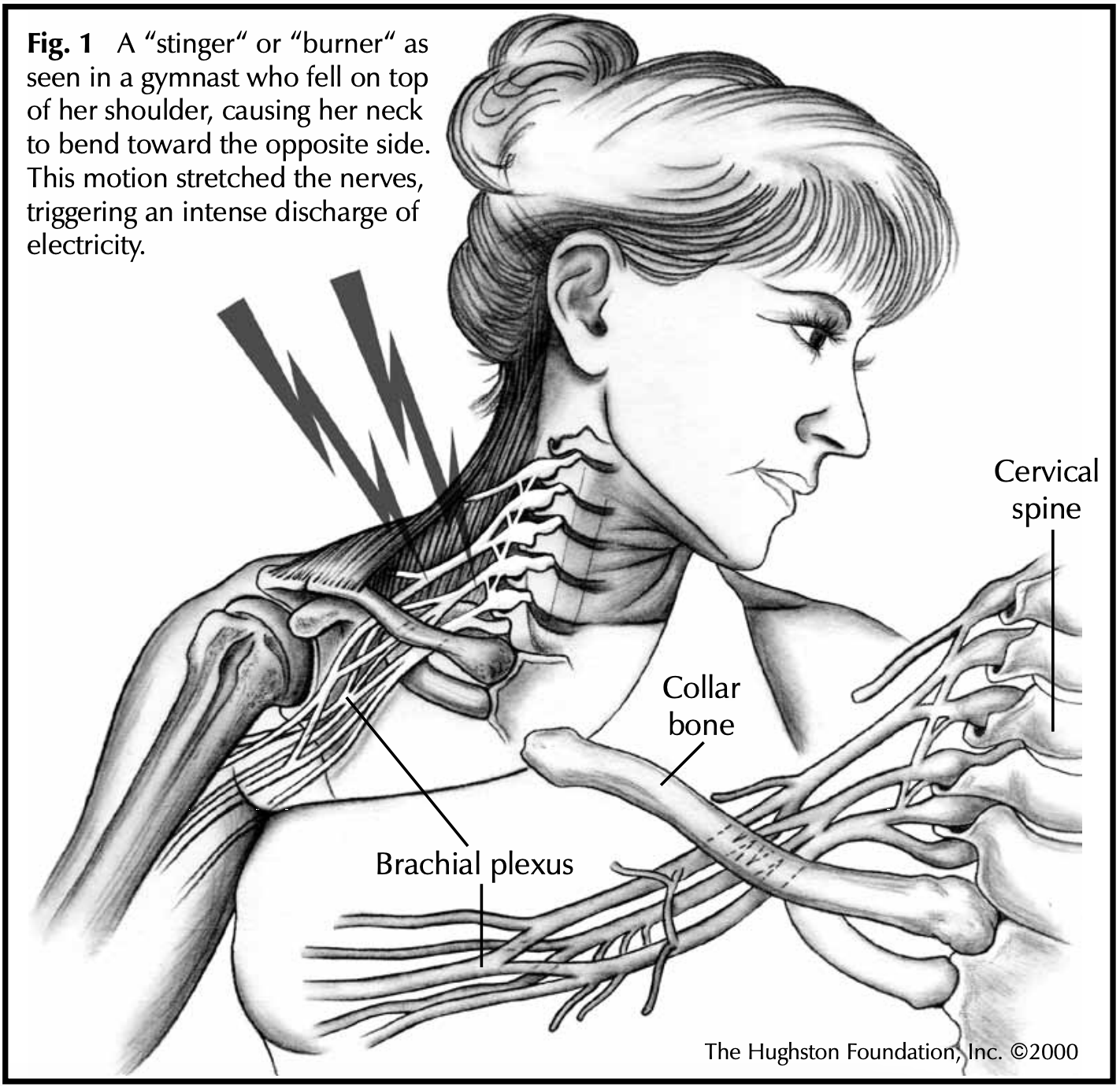 stingers-and-burners-hughston-clinic