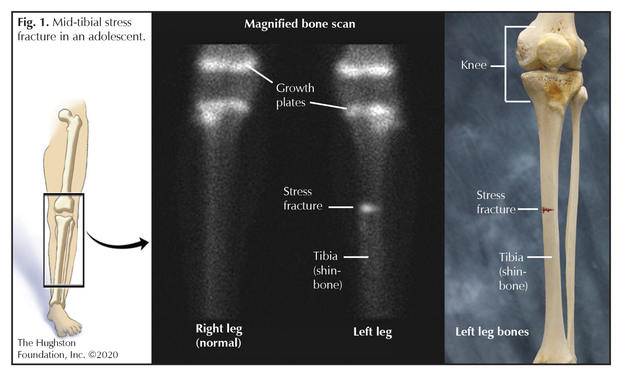Stress Fractures in Adolescent Athletes Hughston Clinic