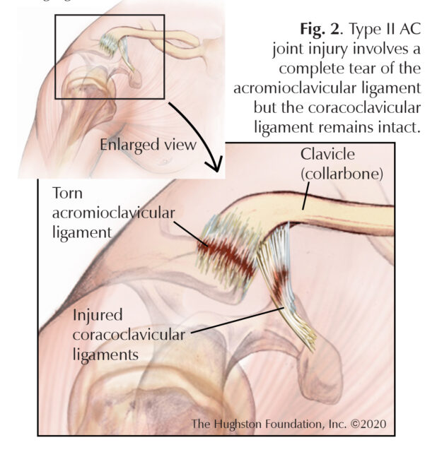 AC Joint Injuries - Hughston Clinic