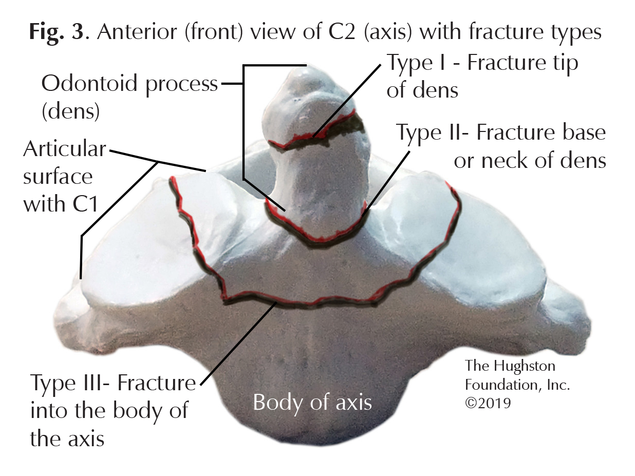 Odontoid Fractures Hughston Clinic Odontoid Fractures Hughston Clinic