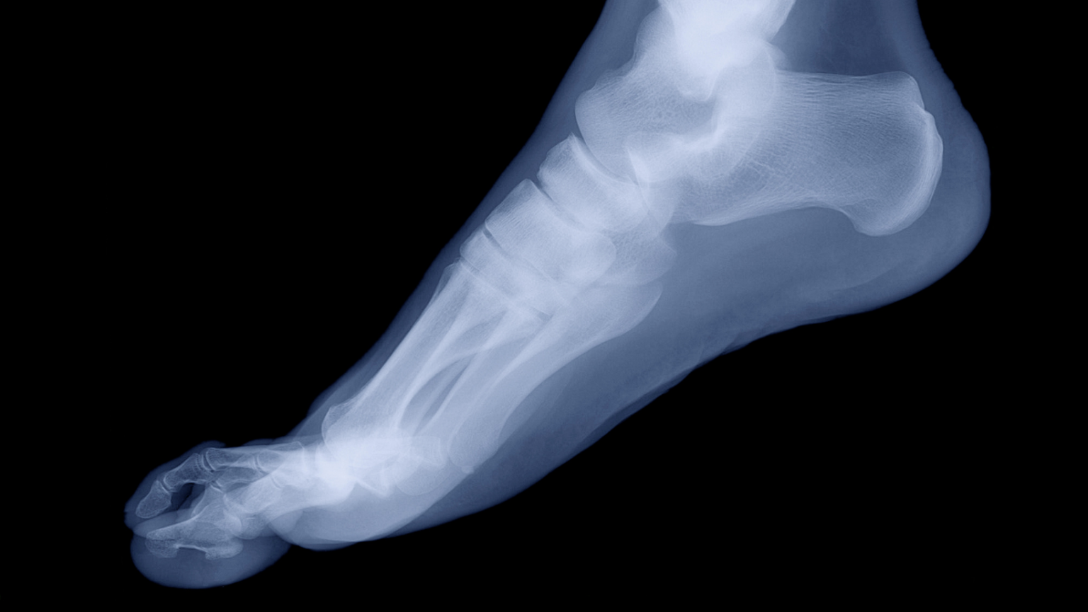 Hallux Rigidus - Hughston Clinic