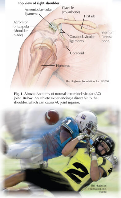 Shoulder acromioclavicular joint injuries common in athletes