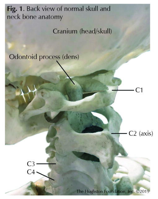 Odontoid Fractures Hughston Clinic