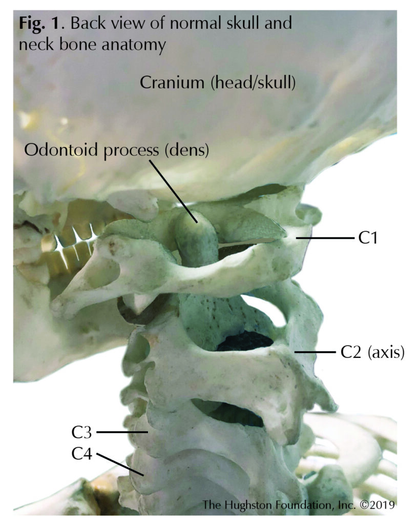 Odontoid Fractures Hughston Clinic Odontoid Fractures Hughston Clinic