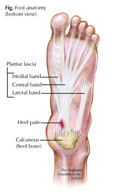 Haglunds Deformity: Bump and Back of Heel Pain