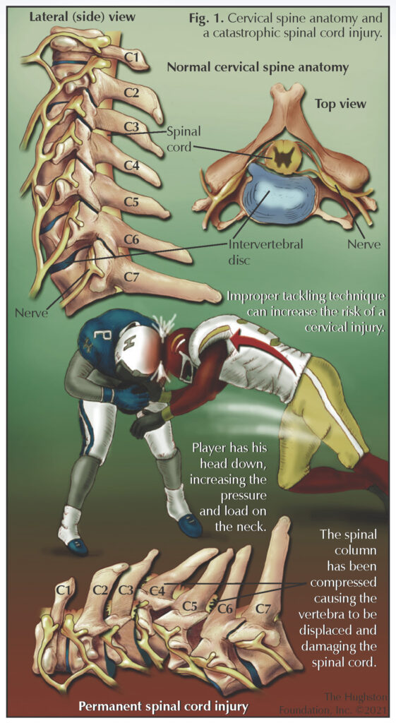 Cervical Spine Injuries in Sports - Hughston Clinic