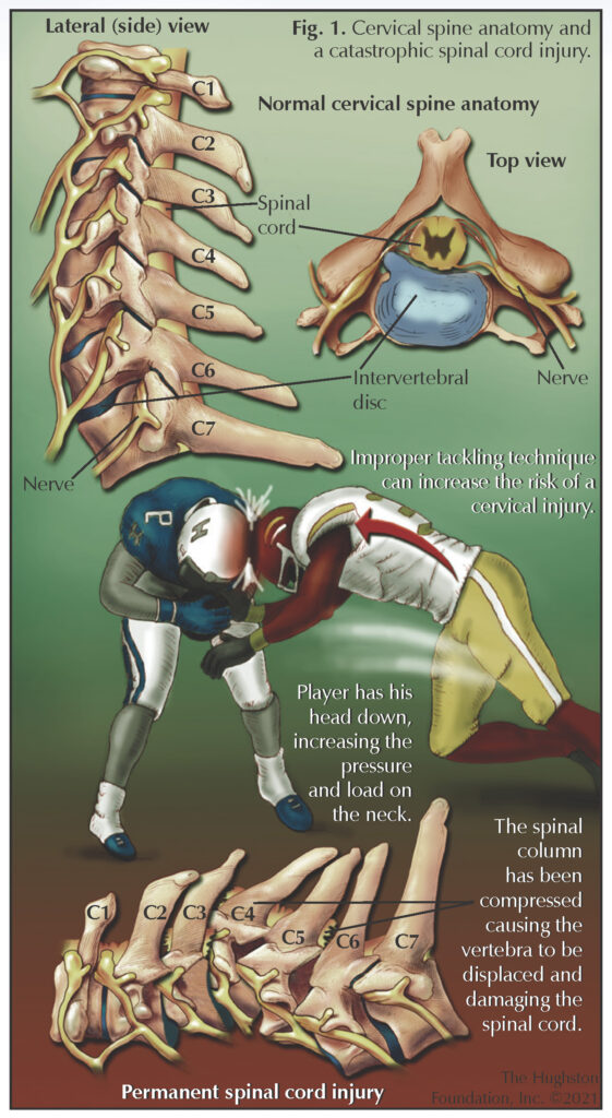 Cervical Spine Injuries in Sports Hughston Clinic