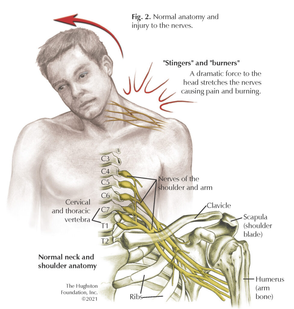 Cervical Spinal Cord Injury