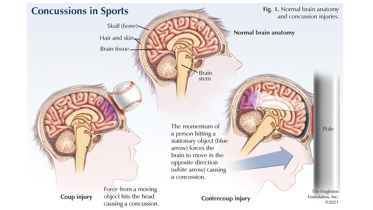 Can I Exercise With Mild Concussion