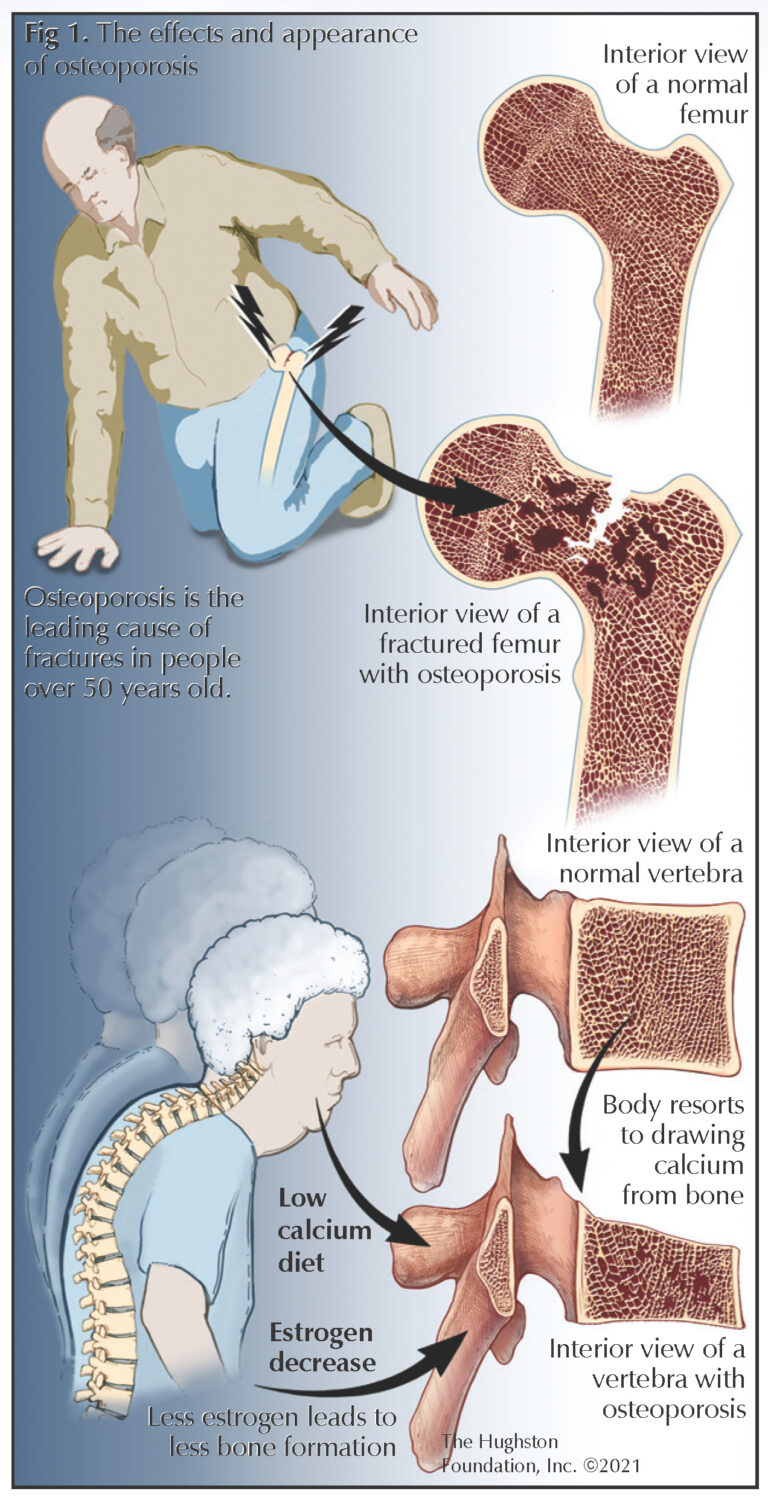 Osteoporosis hughston clinic